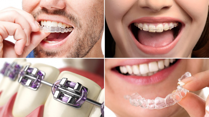 Braces Have Changed, From Metal to Tooth-Colored to Clear