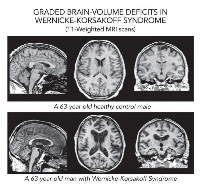 Graded brain-volume deficits in wernicke-korsakoff syndrome (T1-weighted MRI scans). Three images of brain scans showing a normal brain and three images of brain scans showing wernicke-korsakoff syndrome..