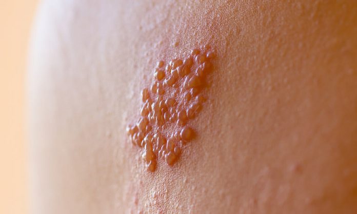 What’s the most effective way to prevent shingles? Getting vaccinated