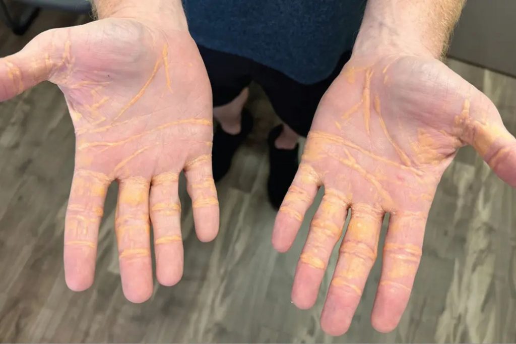 Man’s Hands Seemingly Turn Yellow After Only Eating Butter, Cheese and Meat in Viral ‘Carnivore Diet’