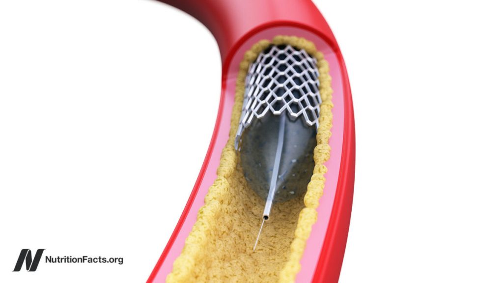 Why Aren’t Angioplasty Heart Stents More Effective? Why Aren’t Angioplasty Heart Stents More Effective?