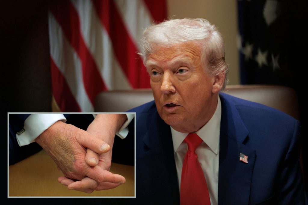 Trump’s Nearly 5-Hour Physical Exam Raises Questions About His Health After Massive Bruise Saga