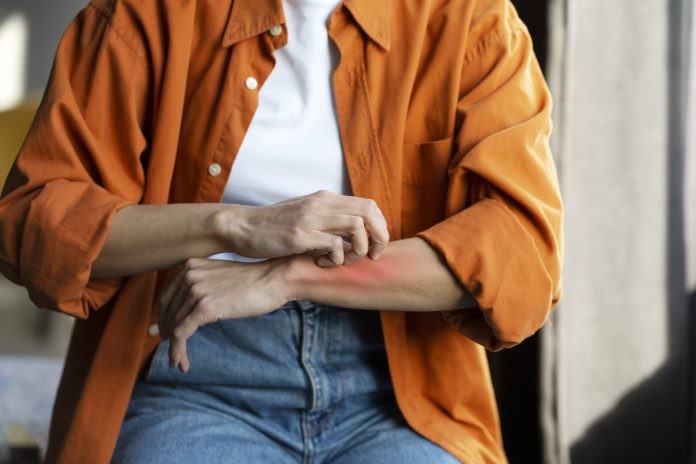 Post-Travel Dermatologic Conditions | Yellow Book