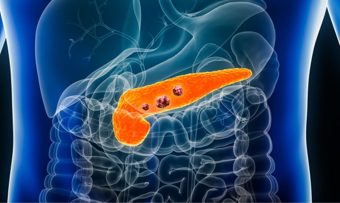 Pancreatic cancer: What you need to know