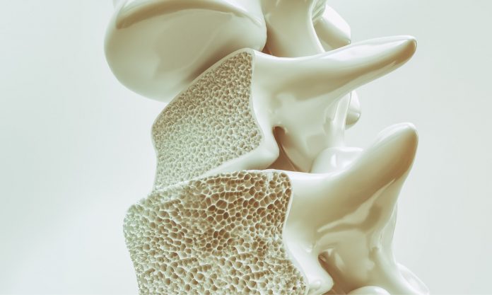 Osteoporosis: What you need to know