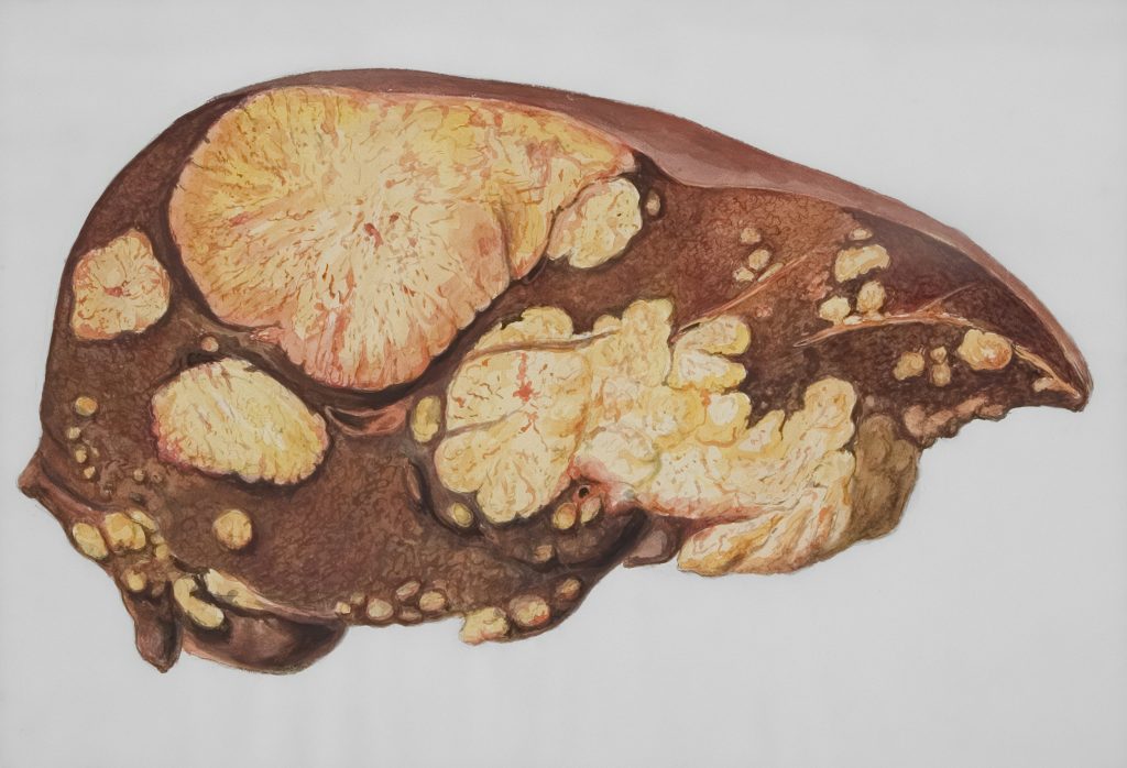 NAFLD Symptoms and Liver Fat Causes Explained