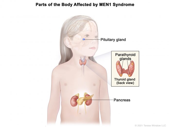 Childhood MEN1 Syndrome - NCI