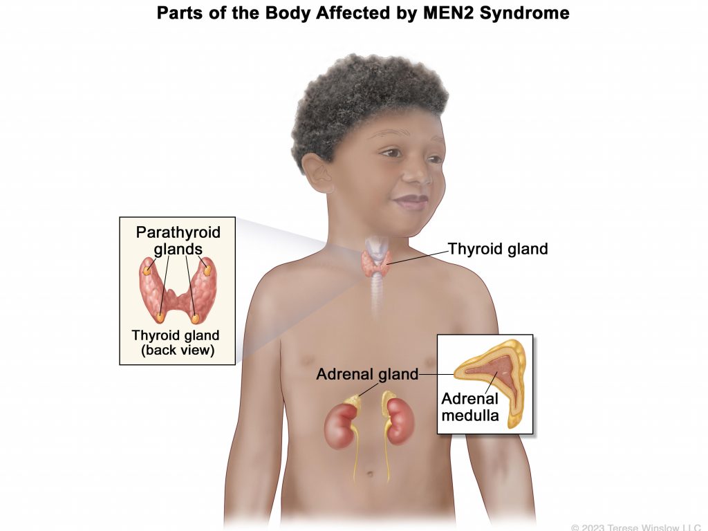 Childhood MEN2 Syndrome – NCI Childhood MEN2 Syndrome – NCI