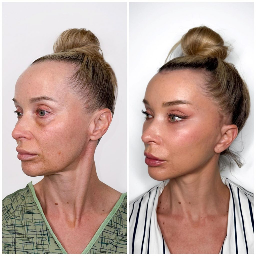 Inside the World of Facial Feminization Surgery with Dr. Harrison Lee