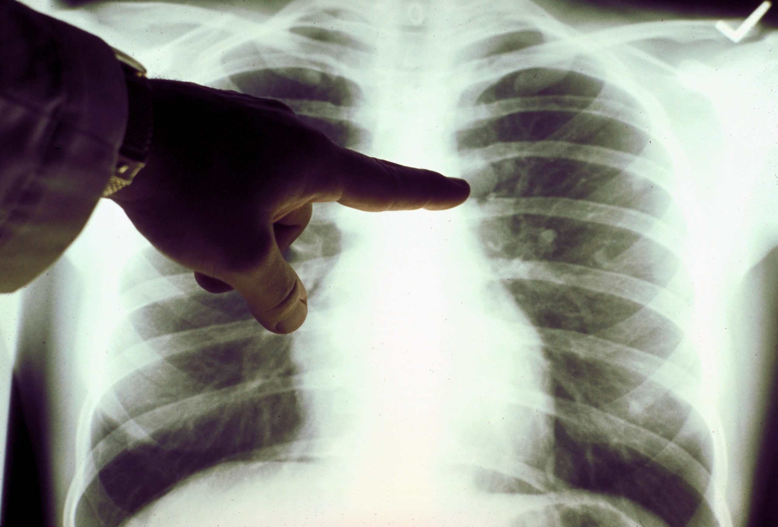 Medscape Report Finds Cytoreductive Surgery During TKI Therapy May Extend Survival in EGFR-Mutated Lung Cancer Patients Medscape Report Finds Cytoreductive Surgery During TKI Therapy May Extend Survival in EGFR-Mutated Lung Cancer Patients